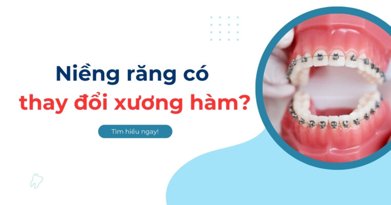 niềng răng có thay đổi xương hàm