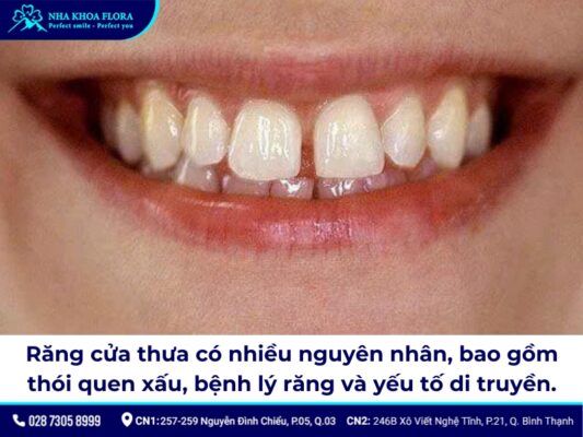 niềng răng cửa thưa - ảnh 2