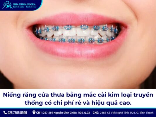 niềng răng cửa thưa - ảnh 3
