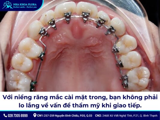 niềng răng cửa thưa - ảnh 5