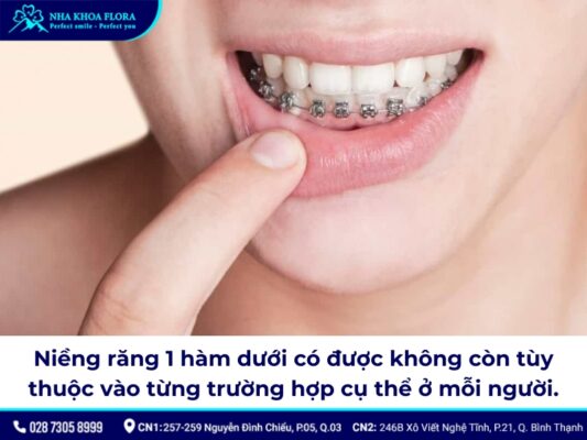 niềng răng hàm dưới - ảnh 1
