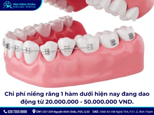 niềng răng hàm dưới - ảnh 4