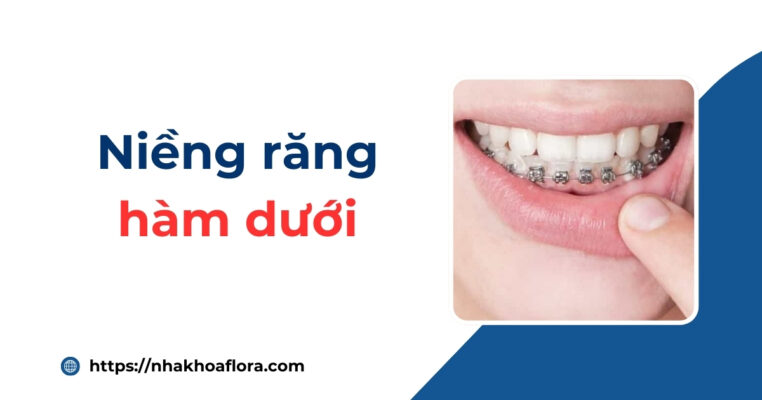 niềng răng hàm dưới