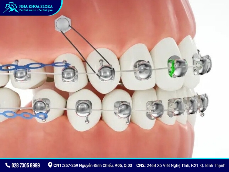 Niềng răng mắc cài cánh cam - ảnh 1 Niềng răng mắc cài cánh cam - ảnh 1