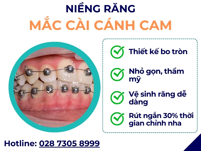Niềng răng mắc cài cánh cam - ảnh 2 Niềng răng mắc cài cánh cam - ảnh 2