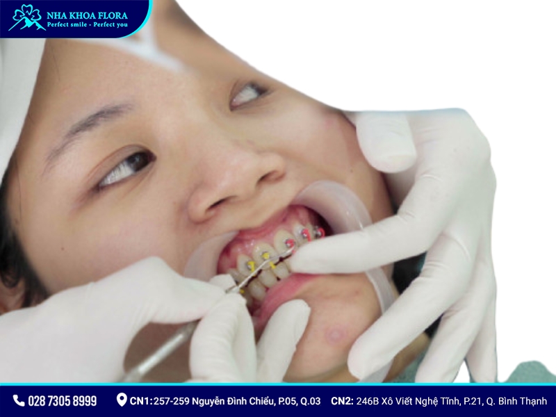 Niềng răng mắc cài cánh cam - ảnh 3 Niềng răng mắc cài cánh cam - ảnh 3