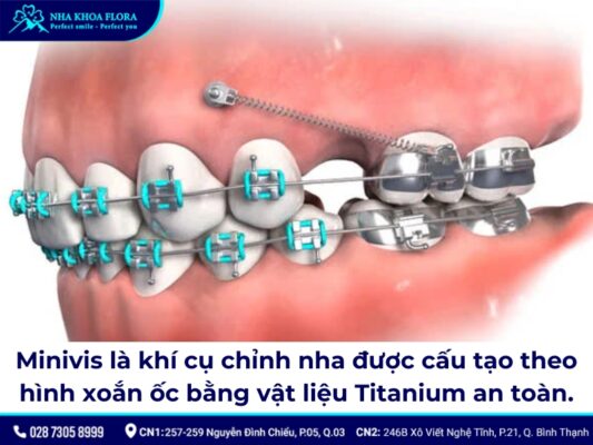 niềng răng minivis - ảnh 1