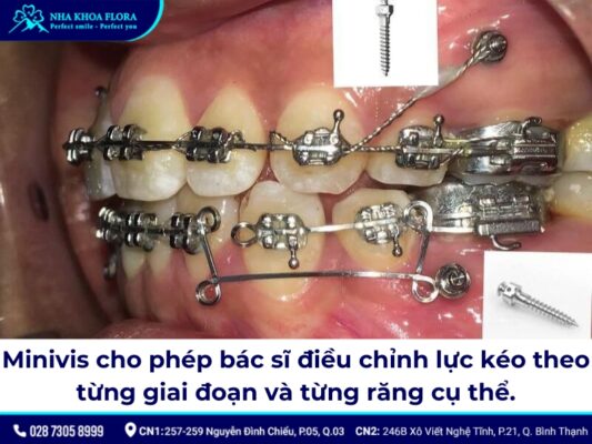 niềng răng minivis - ảnh 2