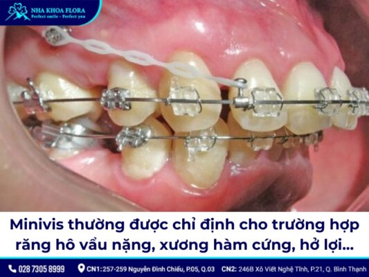 niềng răng minivis - ảnh 3