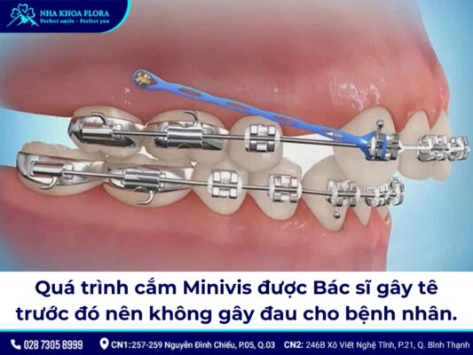 niềng răng minivis - ảnh 4