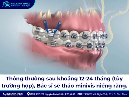 niềng răng minivis - ảnh 5