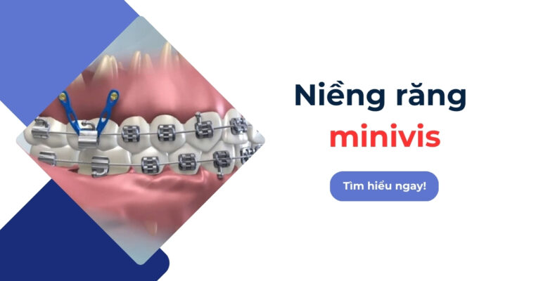 niềng răng minivis