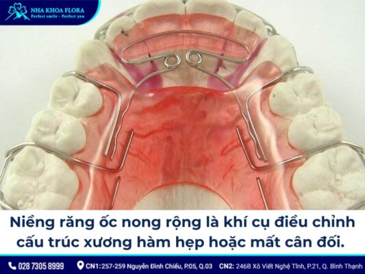 niềng răng ốc nong rộng - ảnh 1