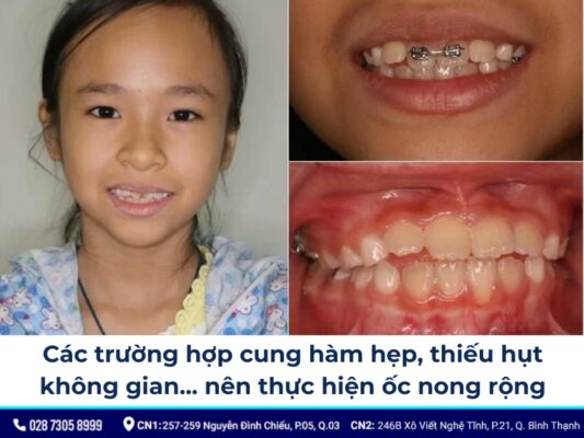 niềng răng ốc nong rộng - ảnh 2