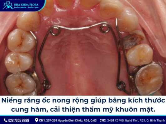 niềng răng ốc nong rộng - ảnh 3