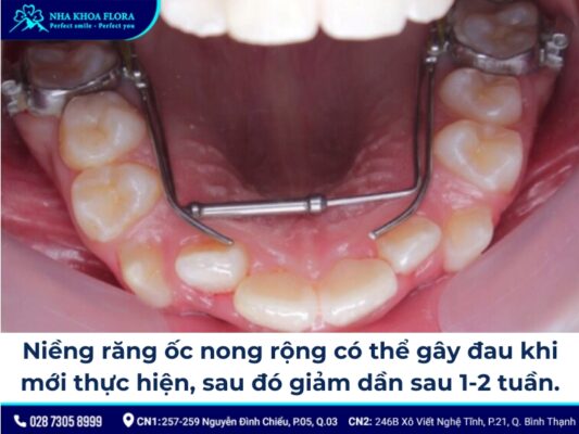 niềng răng ốc nong rộng - ảnh 4