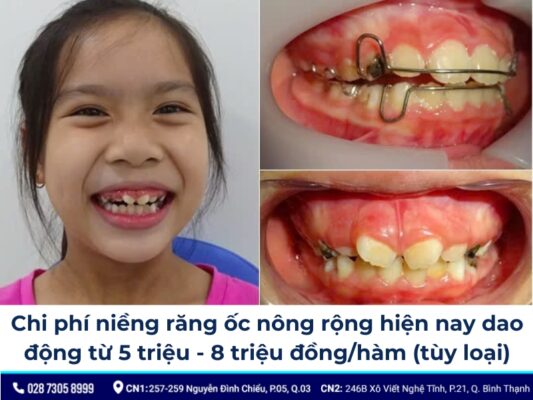 niềng răng ốc nong rộng - ảnh 5