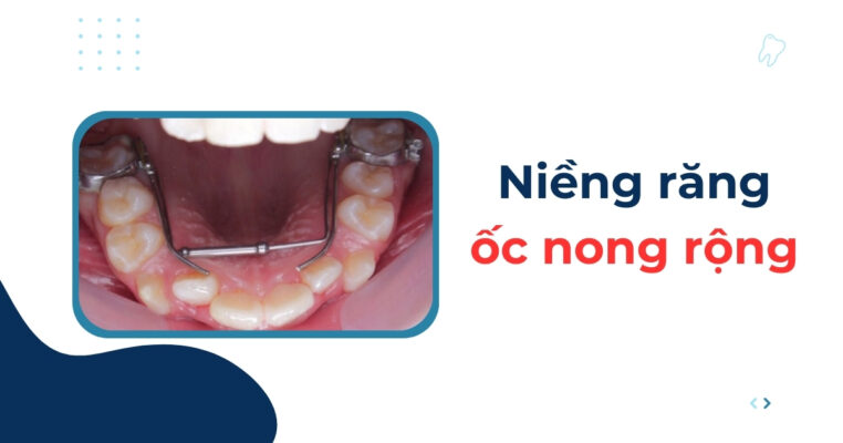 niềng răng ốc nong rộng