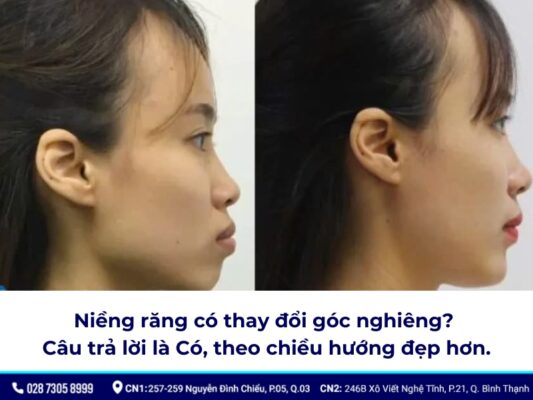 niềng răng thay đổi góc nghiêng - ảnh 1