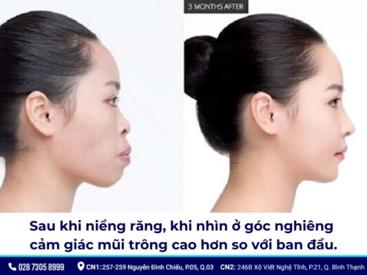 niềng răng thay đổi góc nghiêng - ảnh 2