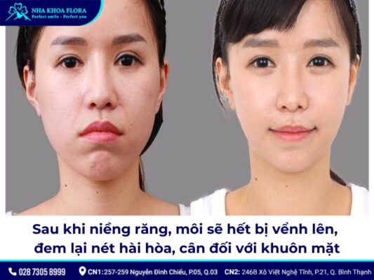 niềng răng thay đổi góc nghiêng - ảnh 3