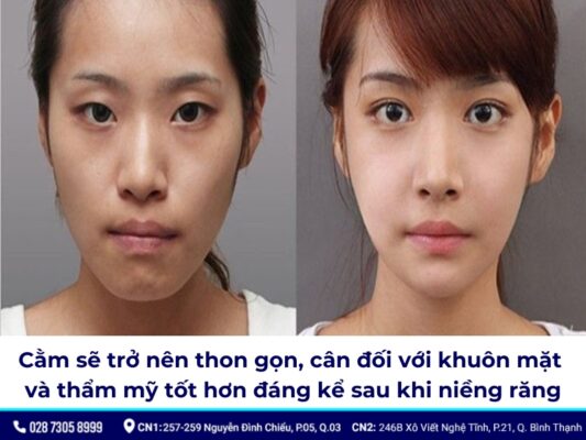 niềng răng thay đổi góc nghiêng - ảnh 4