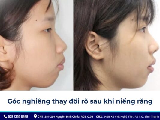 niềng răng thay đổi góc nghiêng - ảnh 5