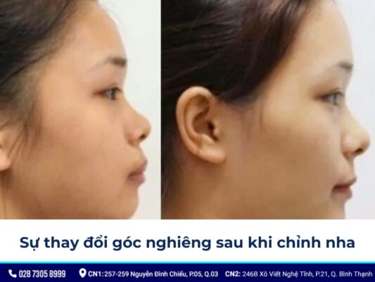 niềng răng thay đổi góc nghiêng - ảnh 6