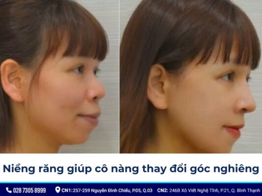 niềng răng thay đổi góc nghiêng - ảnh 7