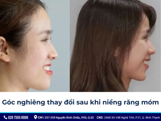 niềng răng thay đổi góc nghiêng - ảnh 8