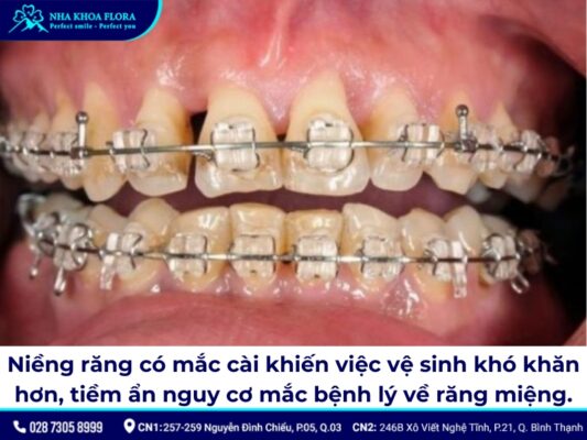 tác hại của niềng răng - ảnh 1