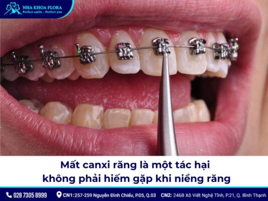 tác hại của niềng răng - ảnh 3