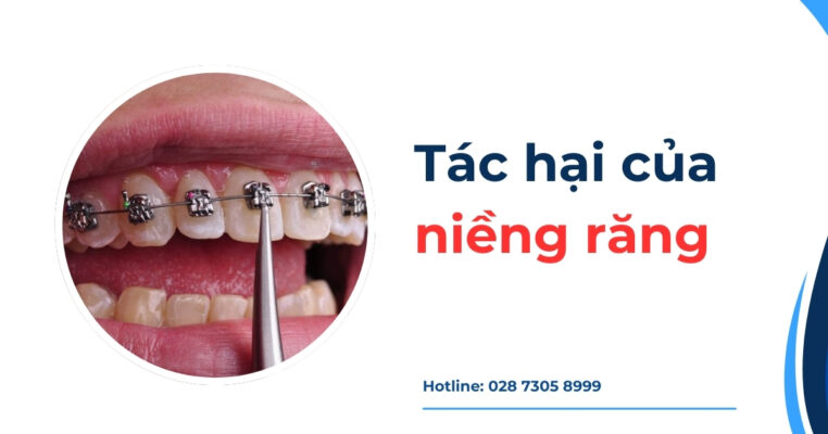 tác hại của niềng răng