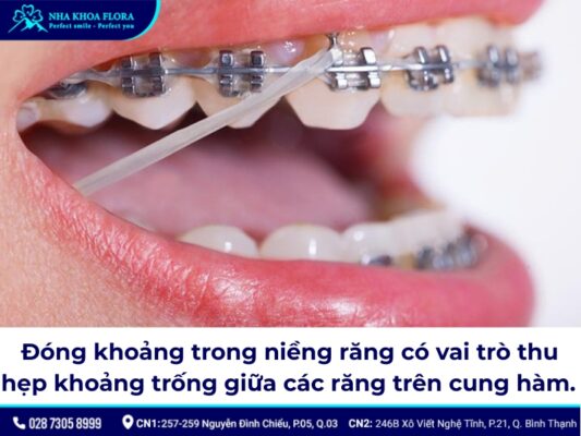 đóng khoảng trong niềng răng – ảnh 1