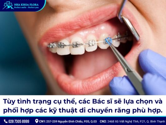 đóng khoảng trong niềng răng – ảnh 2