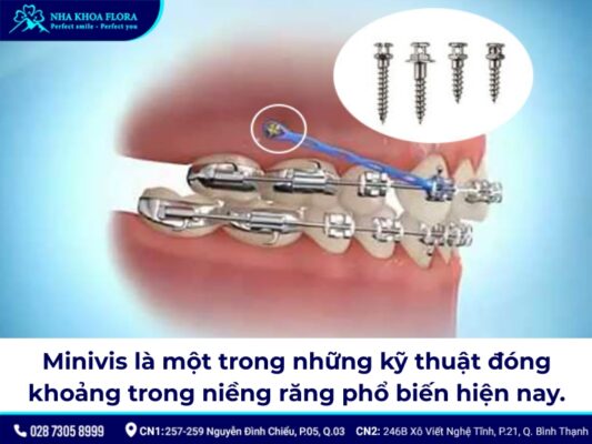 đóng khoảng trong niềng răng – ảnh 3