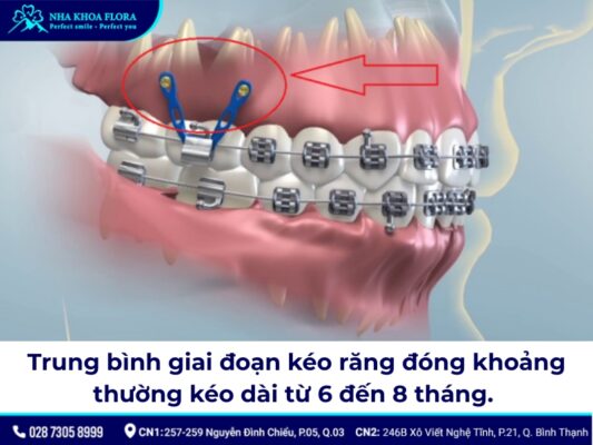 đóng khoảng trong niềng răng – ảnh 4