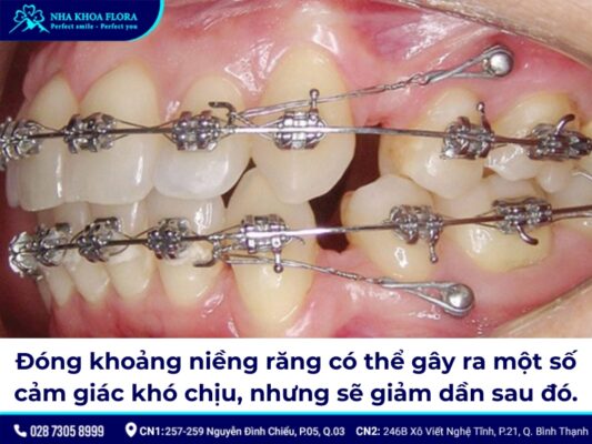 đóng khoảng trong niềng răng – ảnh 5