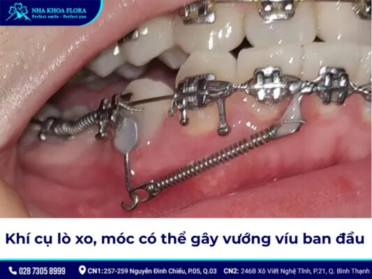 đóng khoảng trong niềng răng – ảnh 6