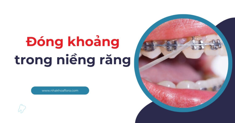 đóng khoảng trong niềng răng
