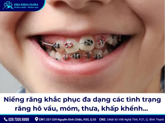giá niềng răng cho trẻ 10 tuổi - ảnh 3