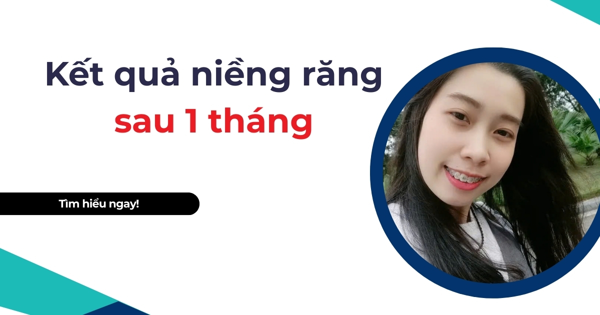 kết quả niềng răng sau 1 tháng