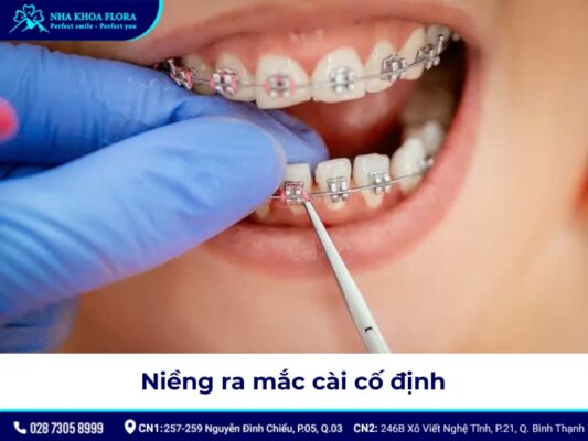 niềng răng cho trẻ 12 tuổi - ảnh 3