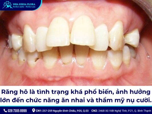 niềng răng hô tại nhà - ảnh 1