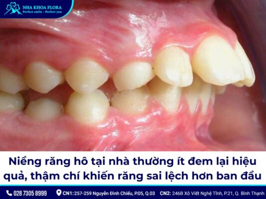 niềng răng hô tại nhà - ảnh 10