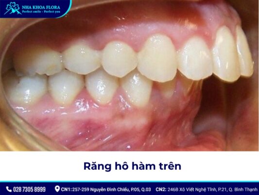 niềng răng hô tại nhà - ảnh 2