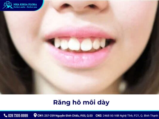 niềng răng hô tại nhà - ảnh 3