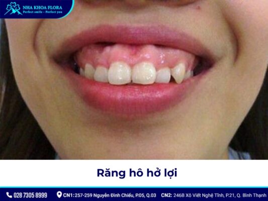 niềng răng hô tại nhà - ảnh 4