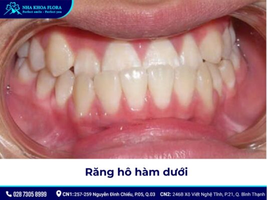 niềng răng hô tại nhà - ảnh 5