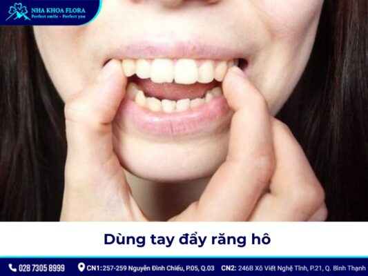 niềng răng hô tại nhà - ảnh 8